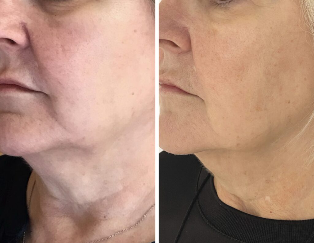 Endolift kezelés 1 év után