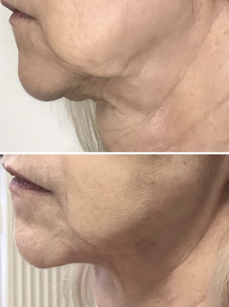 Endolift