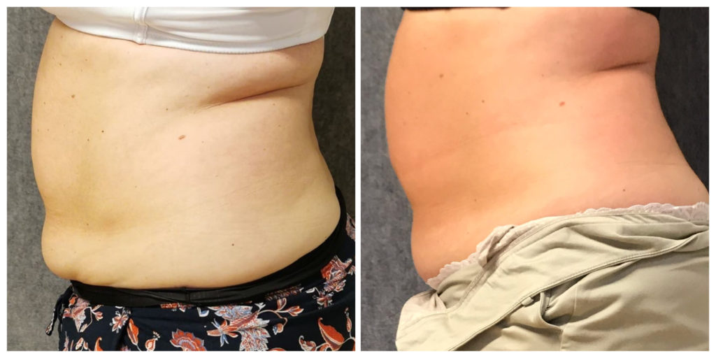 zsírbontás előtt és után