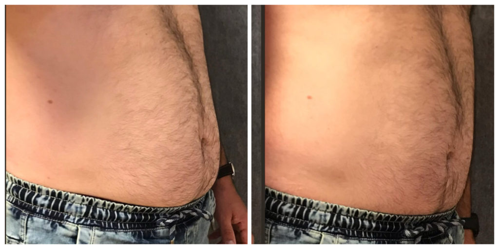 zsírbontás előtt és után