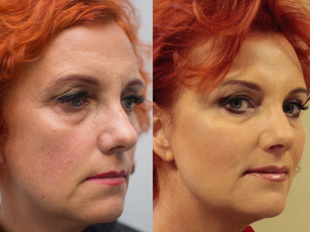 Kezelés előtte utána
