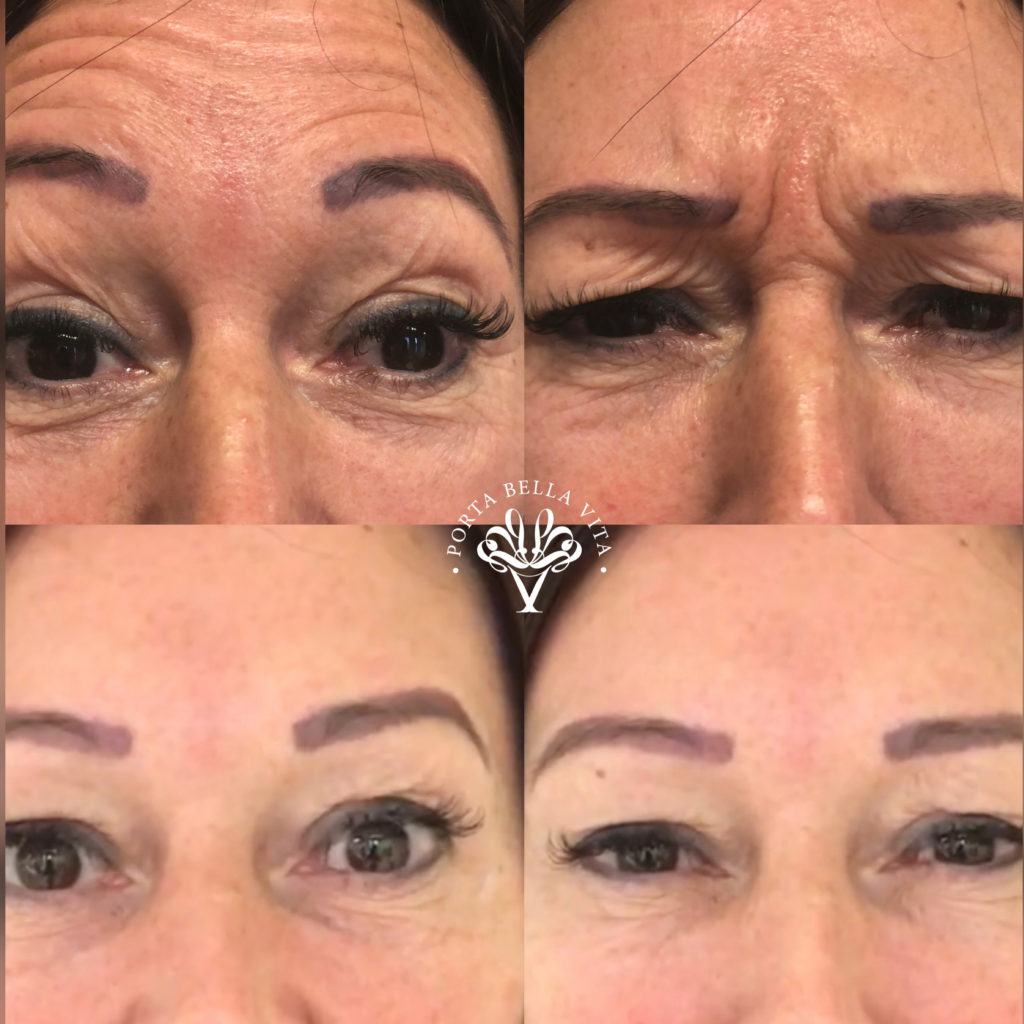 Botox hatása szemkörnyéken - előtte és utána képek 