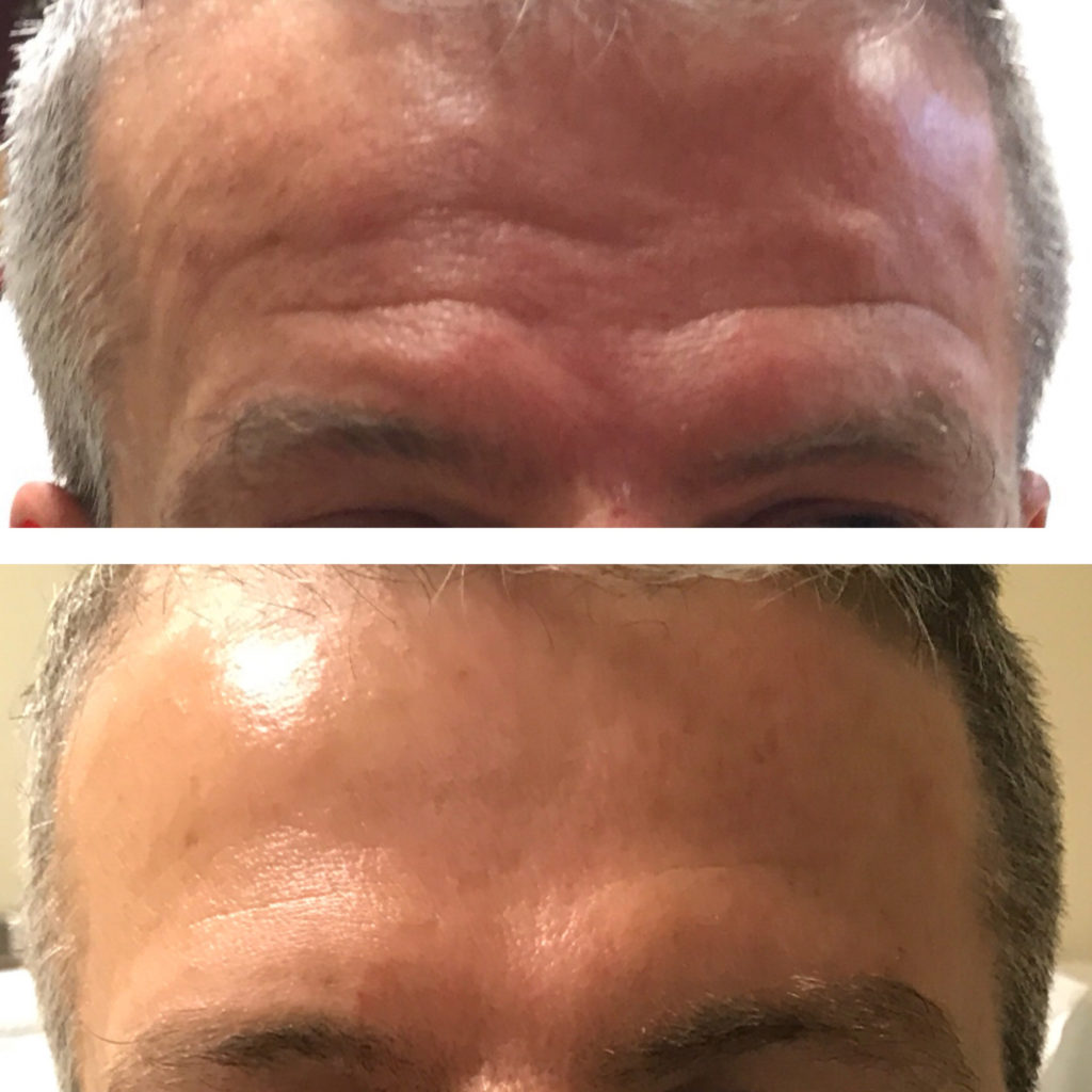 Botox hatása homlokon - előtte utána képek