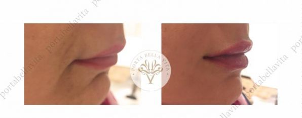 Ajakfeltöltés előtte utána fotók