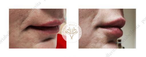 Ajakfeltoltes hyaluronsavval5 porta bella vita