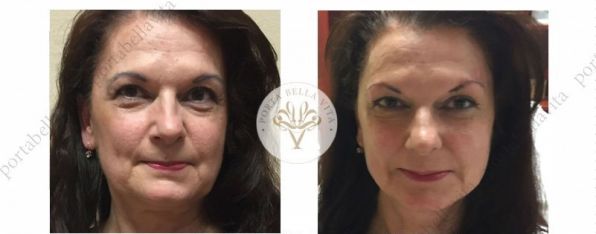 Arcfeszesites vekonyszalas kezeles