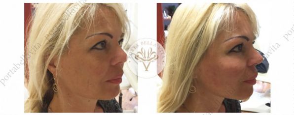 Arcfiatalitas radiesse r 2 porta bella vita