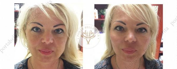 Arcfiatalitas radiesse r porta bella vita