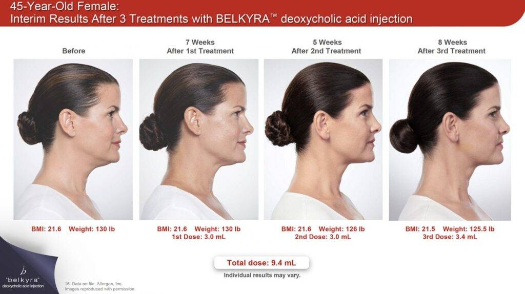 Ba belkyra2 1500x841 1