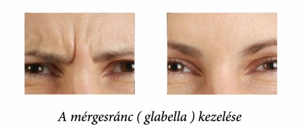 Glabella botox előtte utána