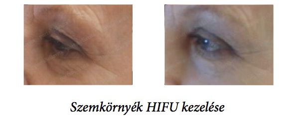 Hifu kezeles szemkornyekre porta bella vita 1