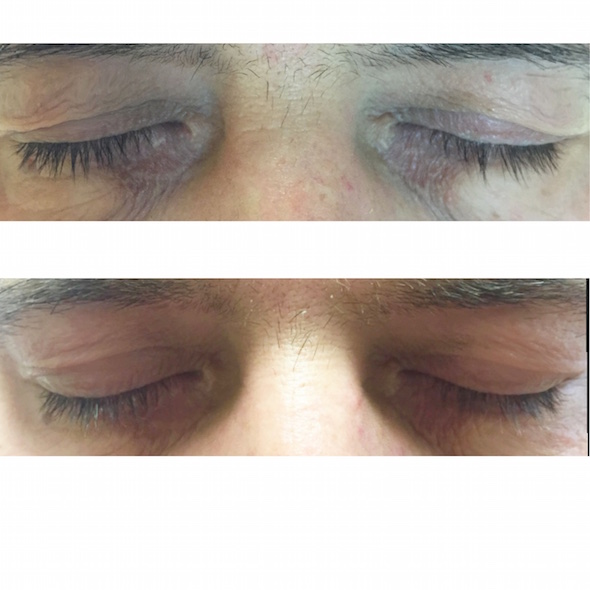 Plasmage insta szemhej 4