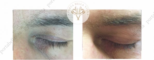 Plasmage szemhej kezeles