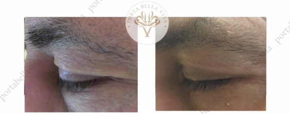 Plasmage szemhej kezeles2