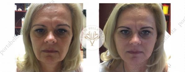 Vekonyszalas monturterapia