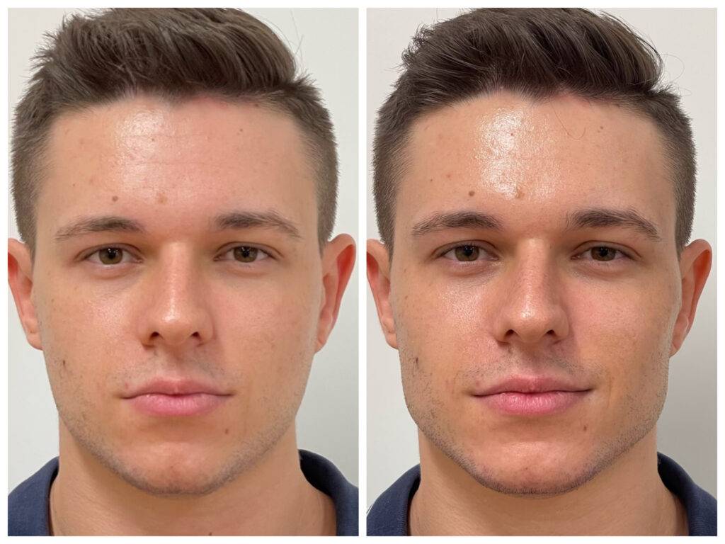 Hyaluronsavas arcfeltöltés férfiaknak