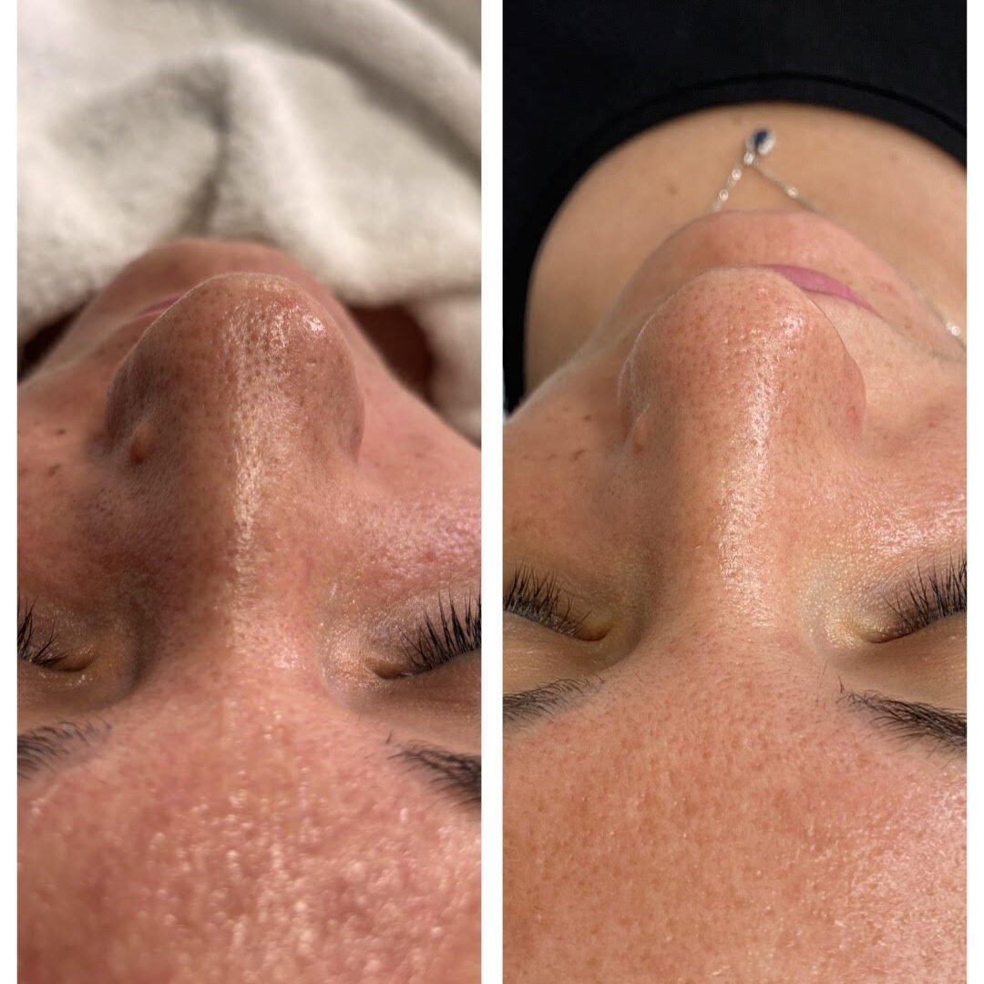 SkinPen eredmény