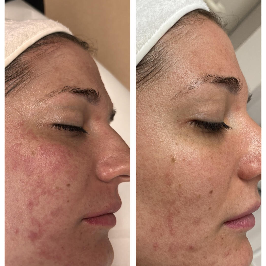 SkinPen kezelés után