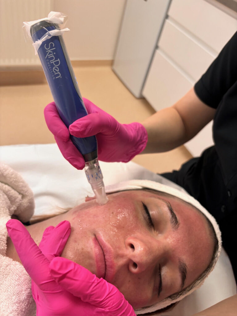 SkinPen Precision kezelés