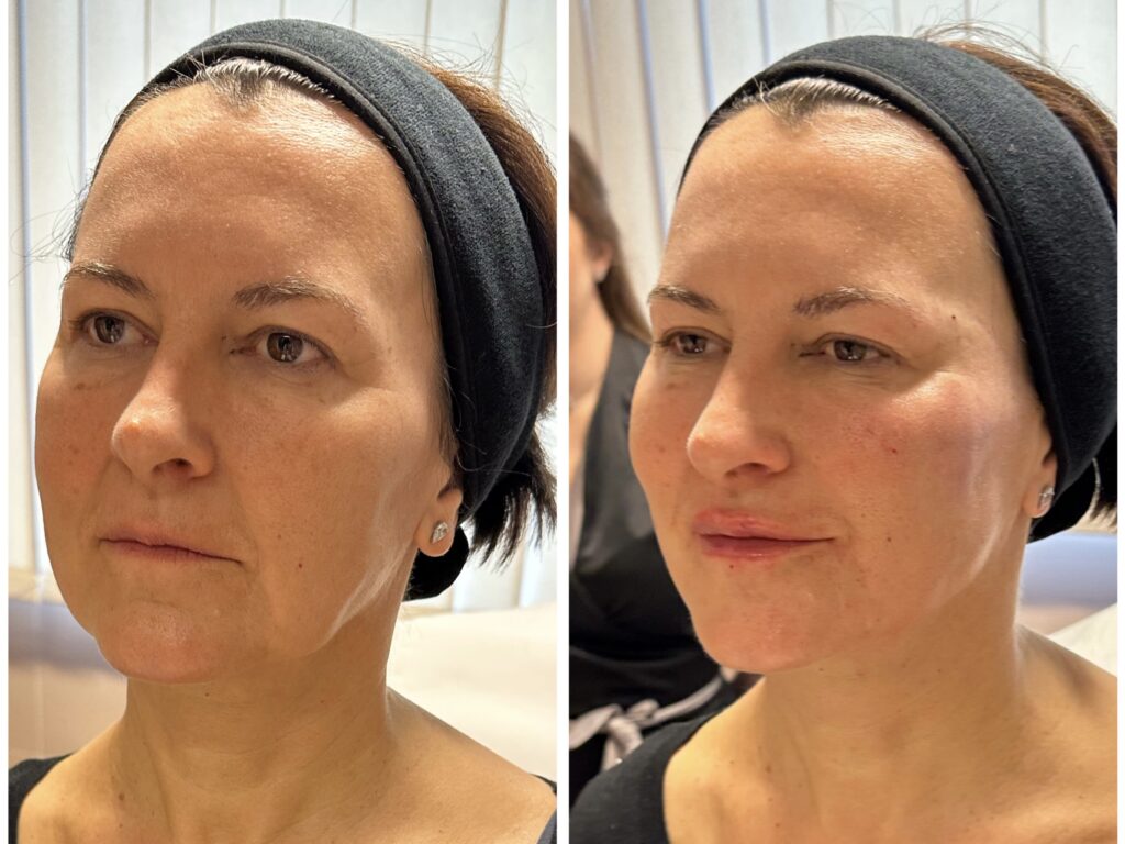 Archarmonizáció HArmonyCa és Juvederm kombinácóval
