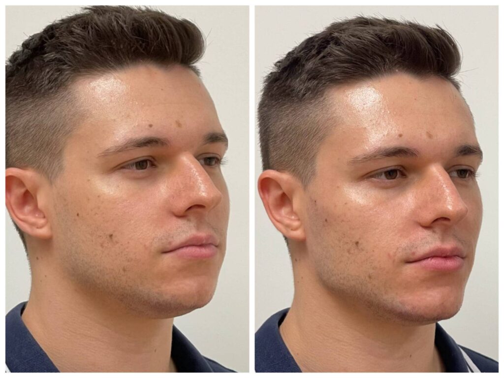 masculinizáció