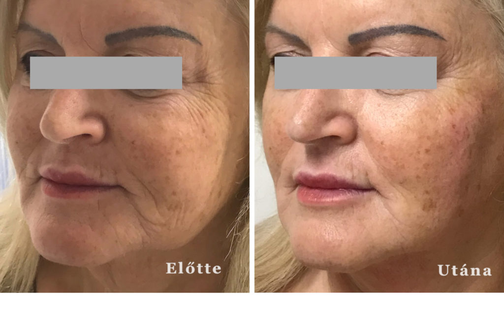 endolift kezelés