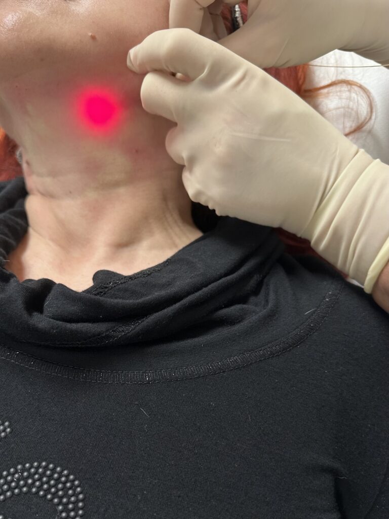 Endolift toka kezelés