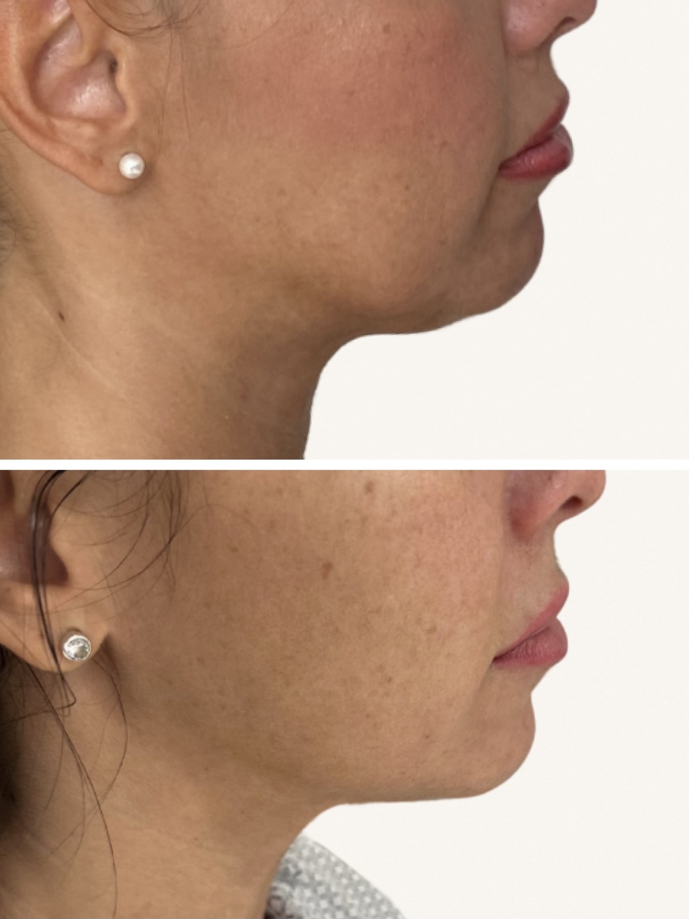 Endolift toka
