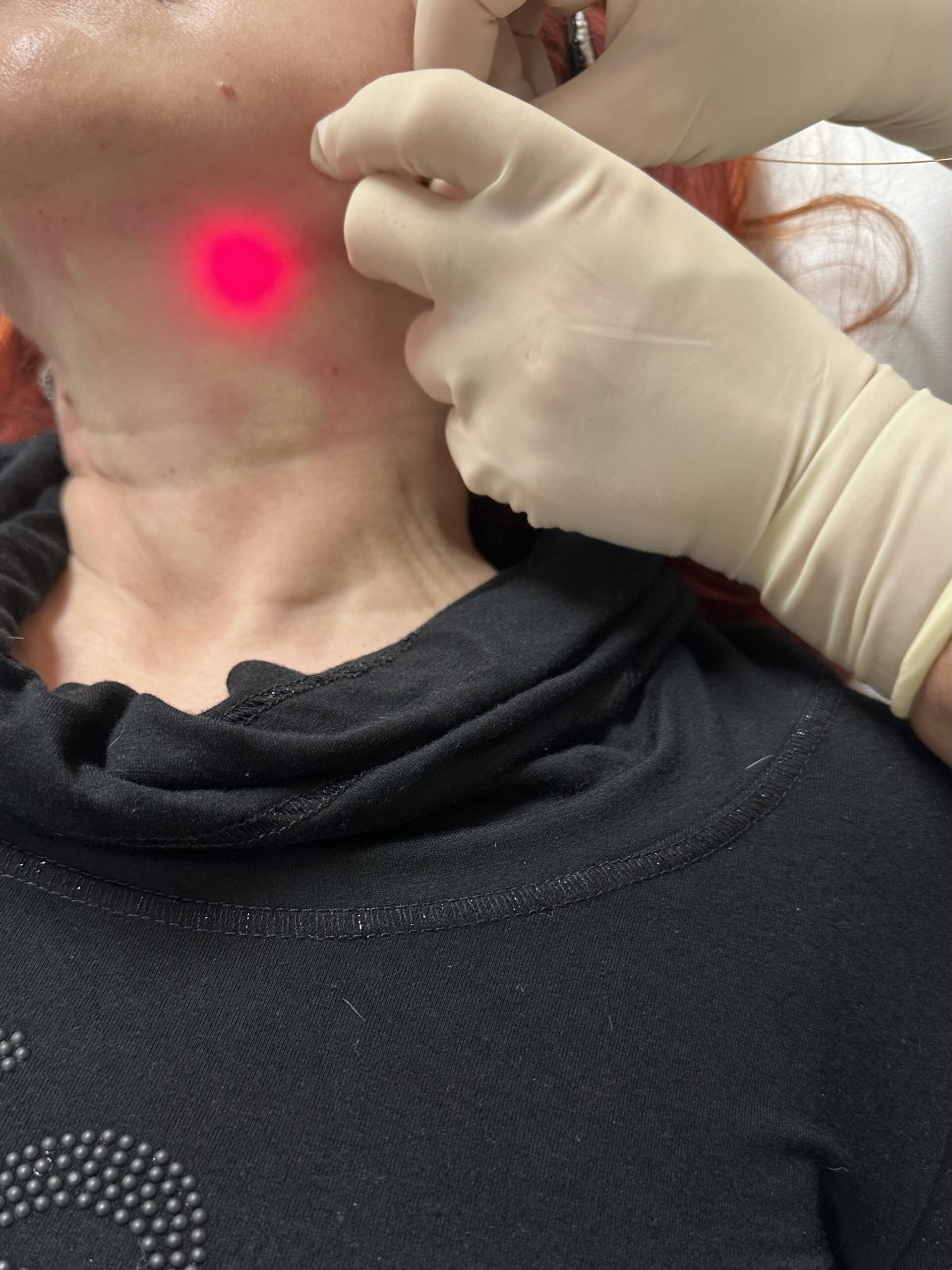 Endolift toka kezelés