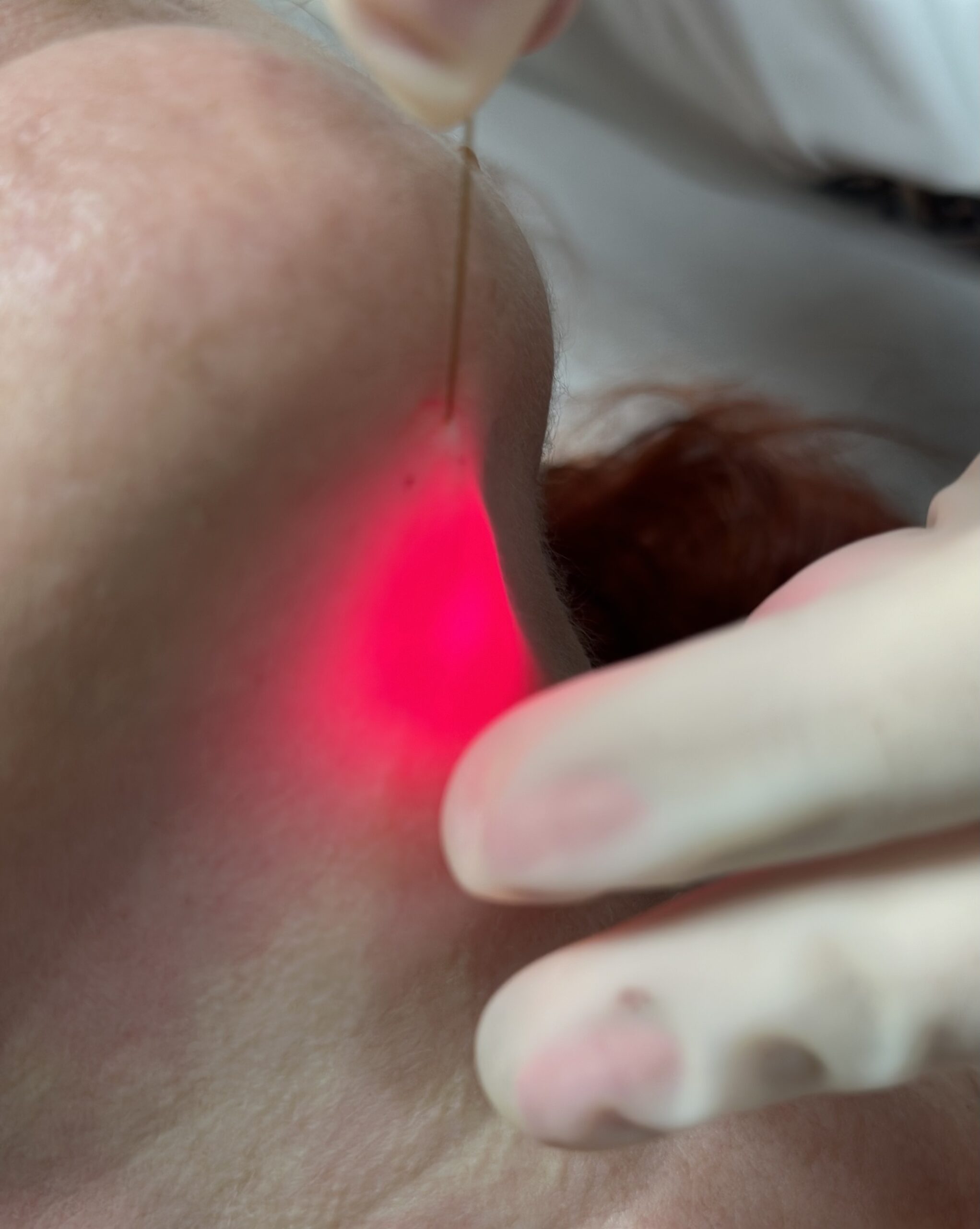 toka endolift