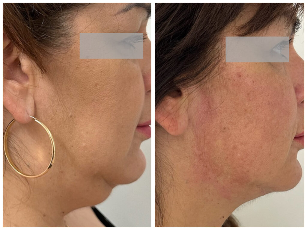 Tokaplasztika és Endolift