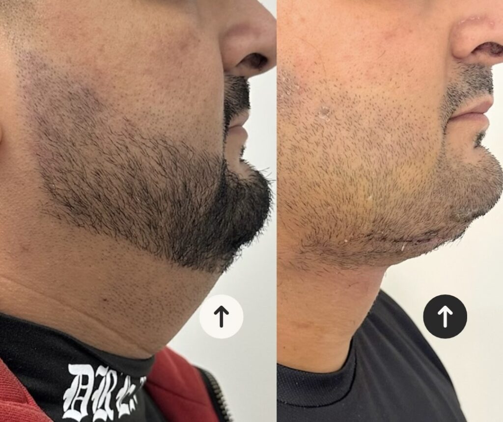 toka és nyakplasztika