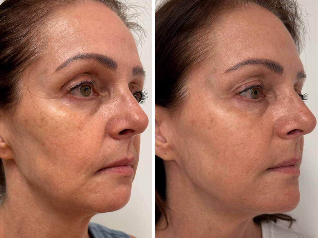 Természetes arcfiatalítás előtte és 2 héttel utána – Ellansé, botox és hialuronsavas kombinált kezelés eredménye