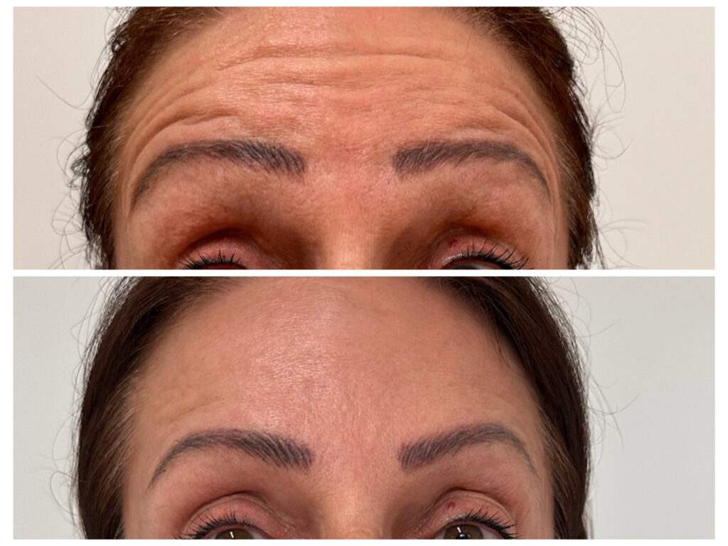 Természetes hatású botox kezelés a mimika megtartásával