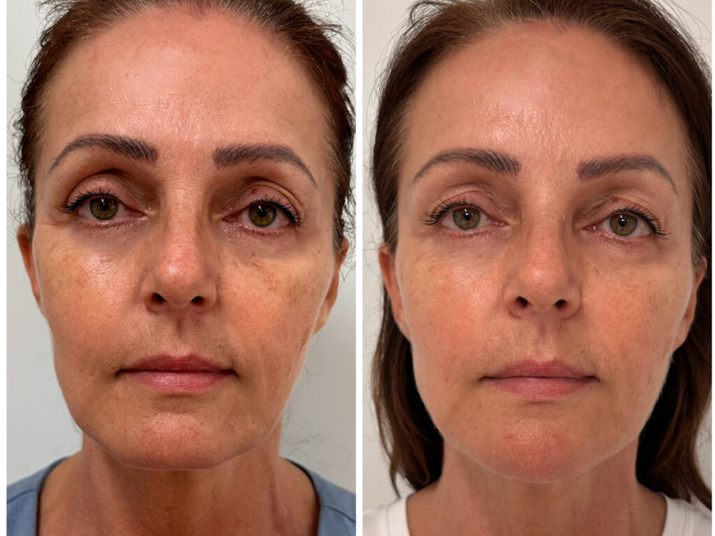 Természetes arcfiatalítás előtte és 2 héttel utána – Ellansé, botox és hialuronsavas kombinált kezelés eredménye