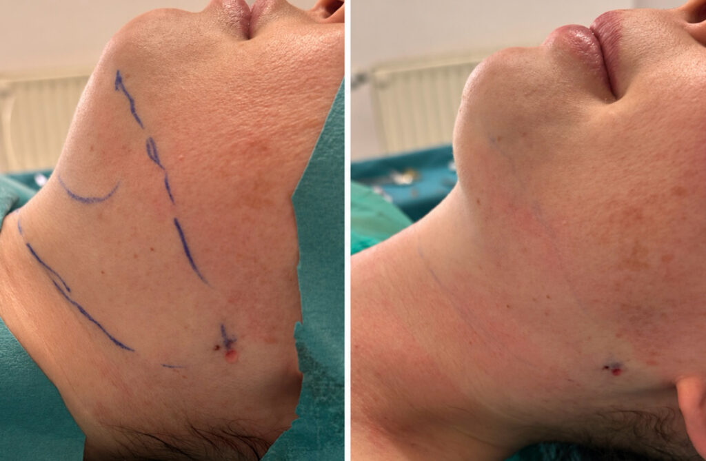áll alatti terület EndoLipo Sculpt lézerasszisztált zsírleszívás előtt és után.